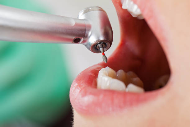 Best Emergency Dentist for Lost Fillings or Crowns in Narragansett Pier, RI